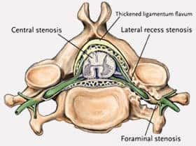 stenosis